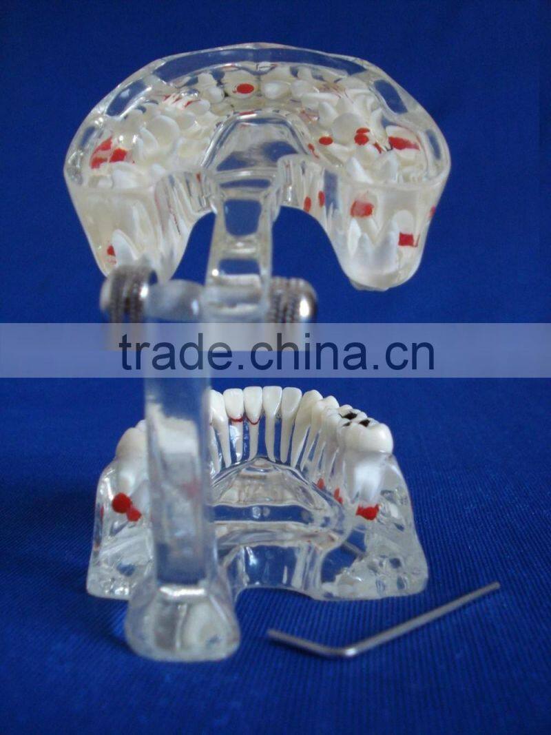 Dental adult pathological dentition model DEA-48 teeth model teaching demonstration