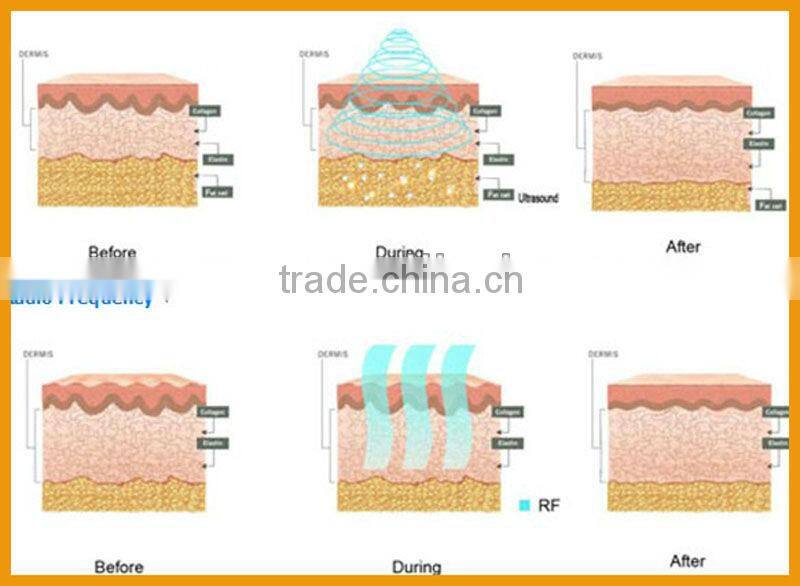 Cryo Machine+Vela Shape Slimming machine Cryotherapy machine RF equipment