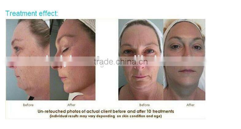 Portable Diamond Peeling Machine/Diamond Peel/Diamond Microdermabrasion Device