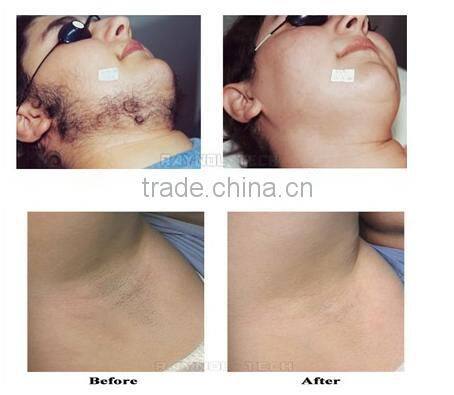 2015 New Products Made In China Germany Suppliers Beauty Salon Equipment for Permanent Hair Removal Machine