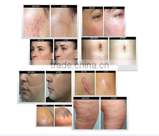 4 in 1 Derma Roller for Skin Whiten and Tighten Hair Loss Treatment Wrinkle Removal for Sale