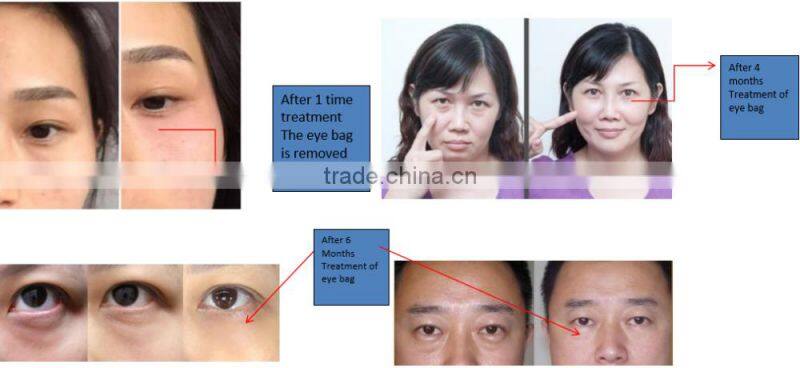 Eye beauty device for removing eye wrinkle ,eye bag