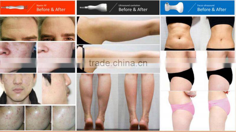 new products 2015 innovative product Hifu slimming /Ultrashape slimming / LipoSonix slimming beauty equipment