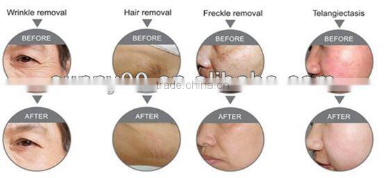 IPL permanent hair reduction