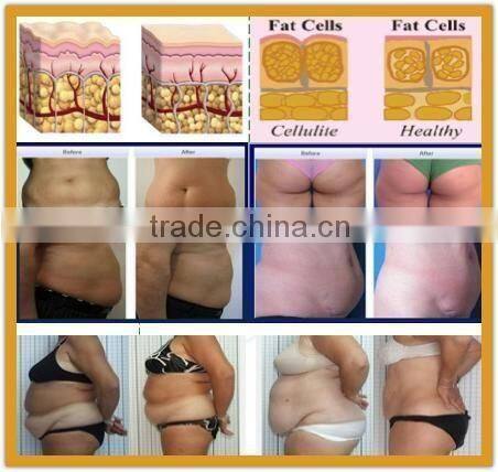 factory provide hottest criolipolisis lipo cryo fat freezing machine 2 handles cryolipolysis body sculpting