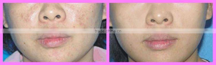 E08 multi-functional ipl machine