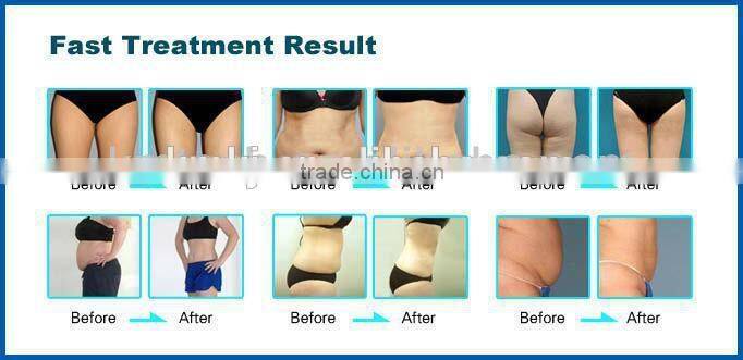 Multifunctional ipl laser rf for hair removal, skin rejuvenation, tattoo removal and weight loss