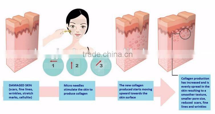 Dermatology Derma Roller,540 Microneedle, Micro Needle 540 for Ageing