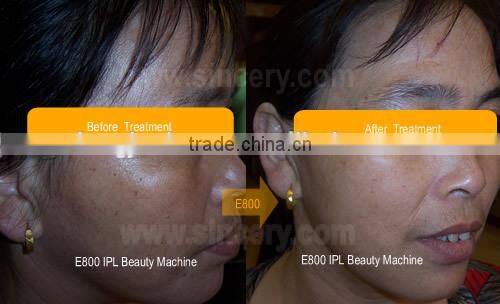 IPL machine for permanent Hair Removal & skin rejuvenation e-light ipl