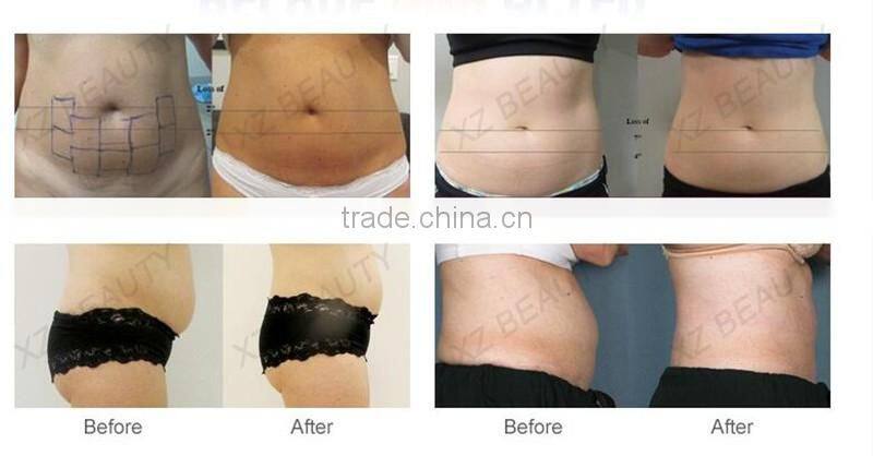 best sliming beauty equipment /slimming weight loss device/hifu slimming machine