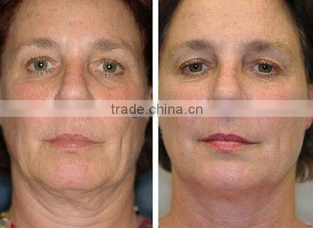 Medical spa equipment wrinkles removal iontophoresis rf machine F-JT01