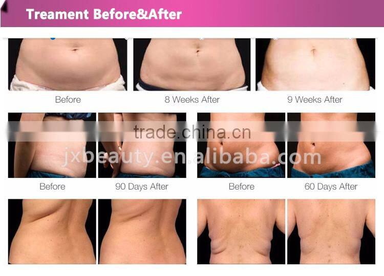 body and face re-shaping 40K cavitation ultrasonic Vacuum Liposuction cavitation Radio Frequency slimming Machine