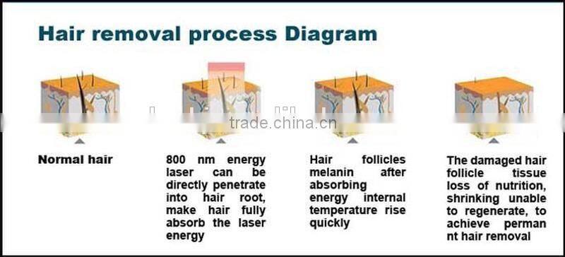 Updated laser diode 808nm diode laser machine with Itlay pump