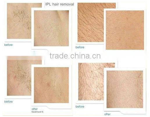 Mini ipl hair acne removal portable machine with 750nm filter