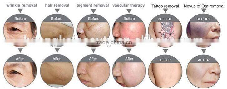 long pulse nd yag laser hair removal machine /nd yag long pulse laser /q switch nd yag laser