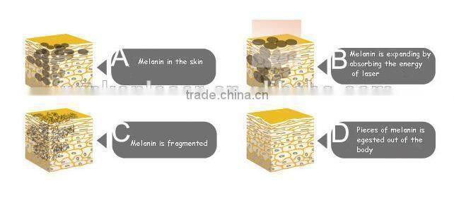 standing q-switch 1064nm 532nm long pulse nd yag laser hair removal machine