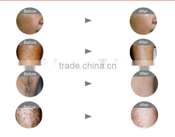 2016 latest best portable diode laser hair removal 808/ laser hair removal body care machine/ laser hair removal candela