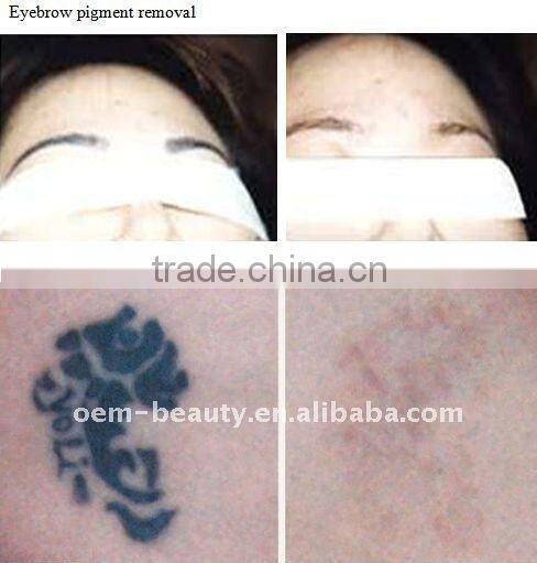 Professional Q switched nd yag laser tattoo removal machine