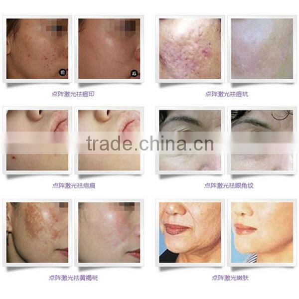 new professional Rhytidectomy Fraction ultrasound skin tightening machine