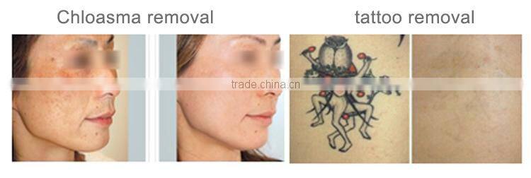 2016 Newest!Low Price Q-switched ND YAG Laser Beauty Salon Equipment / Laser Tattoo Removal