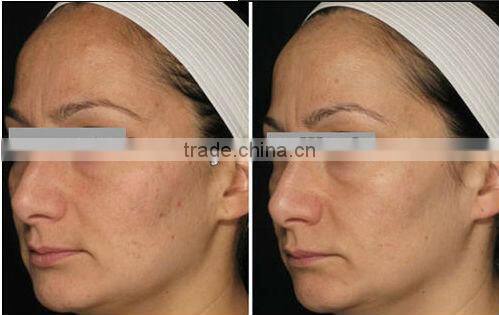 hair loss treatment- medical beauty equipment 1064nm long pulse laser nd yag P003