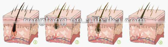 Portable IPL hair removal Medical CE Approved Med-100