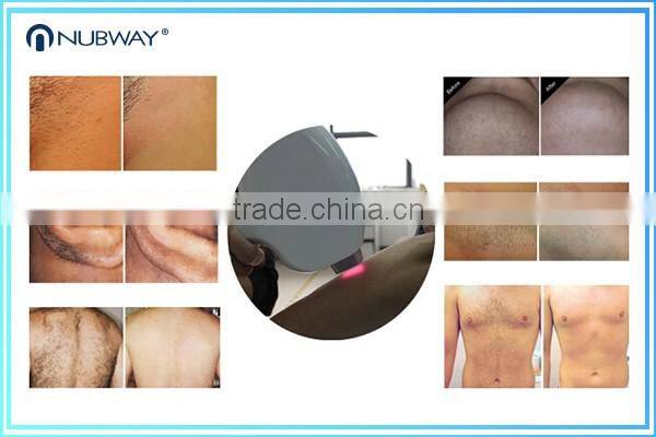 Big Spot 808nm alexandrite Laser Diode Laser Hair Removal Machine