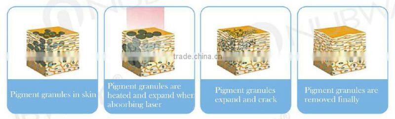 CE Approval Professional 1064nm Yag Laser Tattoo Remover