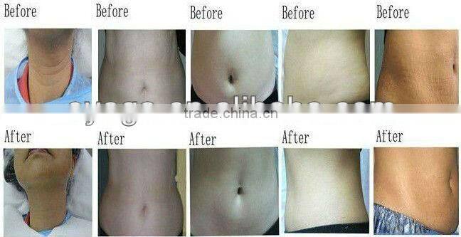 Ultrasonic cavitation fat burner machine/equipment used for spa,salon,medical