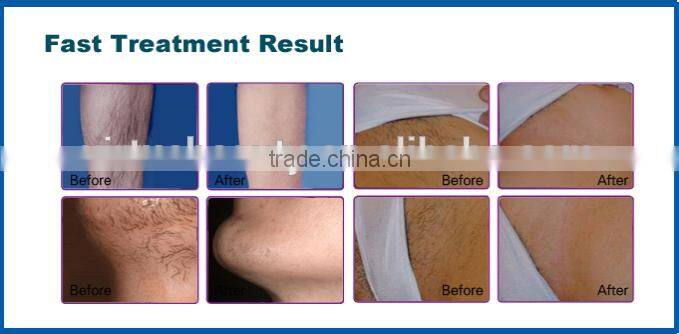 Portable Elight SHR IPL Hair Removal machine /SHR OPT Hair removal