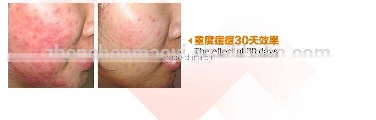 NEWEST! Face Whitening Acne scar Treatment and Pimple Removal Cream