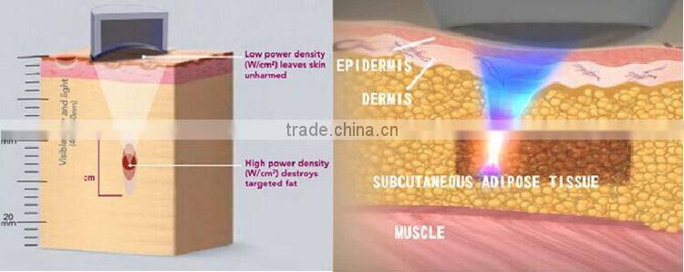 high power hifu ultrasonic cavitation slimming machine for skin rejuvenation