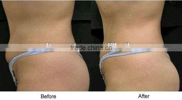 good quality LED ultrasonic multipolar RF liposuction slimming equipment