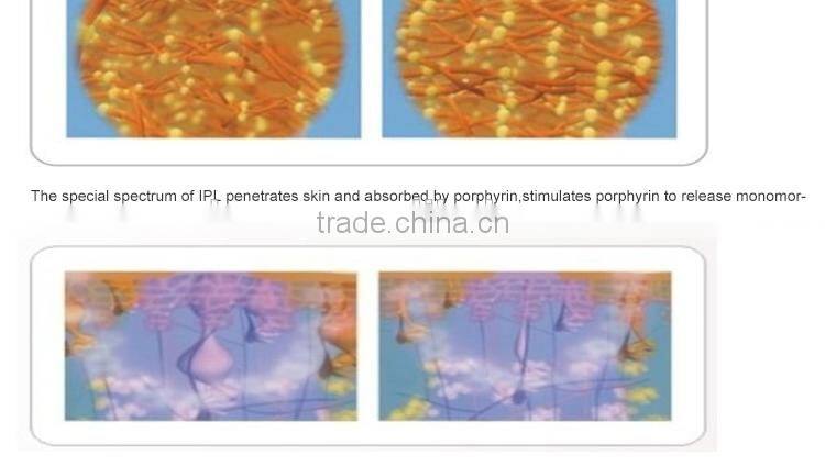 Deess hot sell Whole Body Permanent women facial hair remover