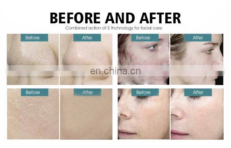 Portable beauty equipment home diamond Dermabrasion tips microdermabrasion machine for sale