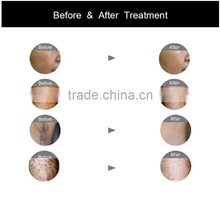 professional laser hair removal machine/P-808 diode laser hair moval