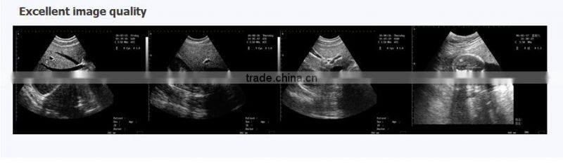 Full Digital Trolley Ultrasound Scanner RUS-5100 for Abdomen, OB/GYN, Small parts, Urology, Cardiology