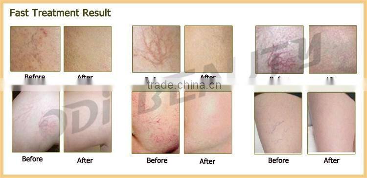 OD-H980 Portable 980nm laser spider vein removal