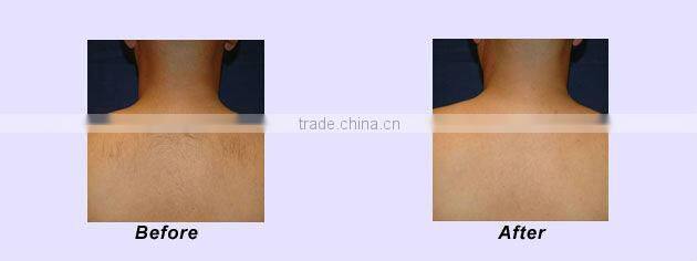 professional laser hair removal machine