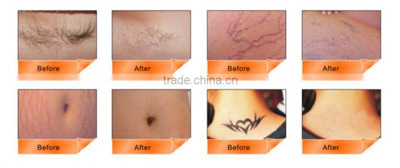 2016 Newest IPL+ND Yag Tattoo Removal+Cooling RF 3 In 1 Multifunction Machine