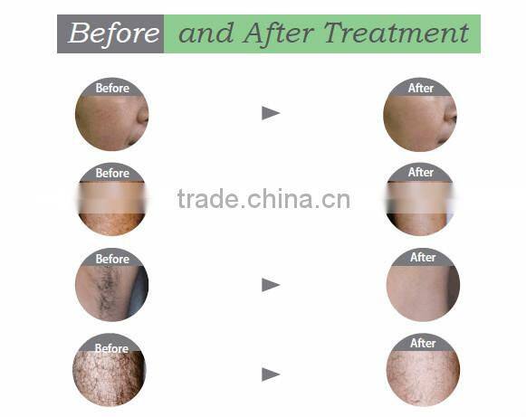 Higher energy e-light ipl shr hair removal laser machine for Spa and clinic