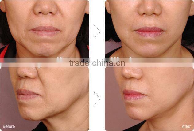 HIFU Facial Beauty Machine for Face lift Brow Lift