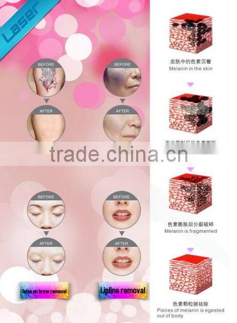 Manufacturer supply!!!! cheapest q switch nd yag laser tattoo removal system
