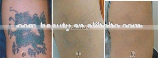 the excellent beauty machine Nd.Yag Laser tattoo removal for sale