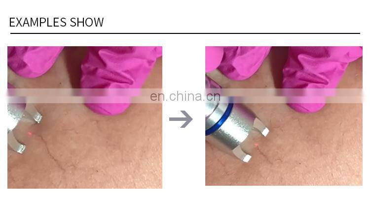 New Portable 980nm Diode Laser Spider Vein Removal Machine Vessels Removal Pore Pigment Removal Skin Tightening Beauty Equipment