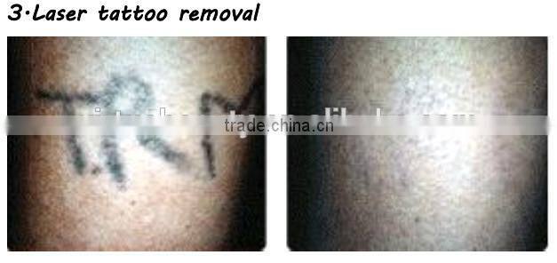 SHR LASER HAIR REMOVAL FOR BEAUTY SALON