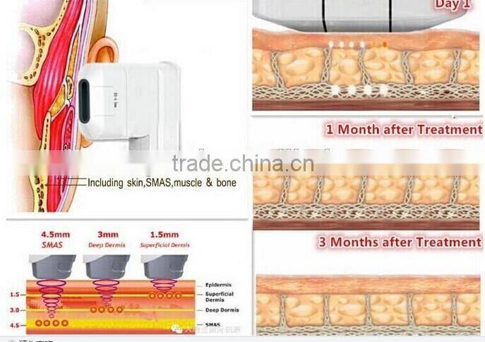 2016 FU 4.5 2S new age ultrasound