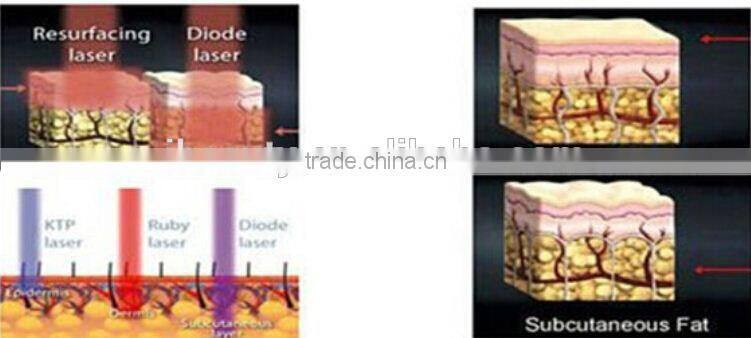 New product cavi lipo laser manufactuer 650nm wavelength laser OEM supplier lipo laser for sale