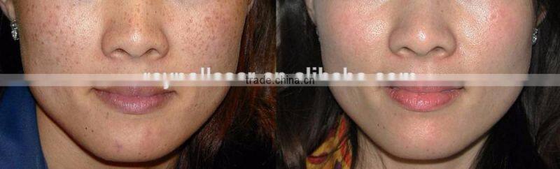 Medical Spa Equipment Alexandrite Laser Permanent Hair Remover for Face