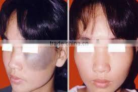 Good quality and competitive price of tattoo removal laser for sale D005